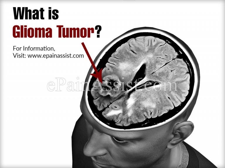 What is Glioma Tumor, Know its Treatment, Life Expectancy, Prognosis, Causes. Symptoms, Classification