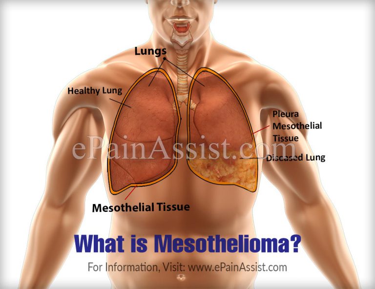 What Is Mesothelioma: Causes, Symptoms, Treatment, Diagnosis