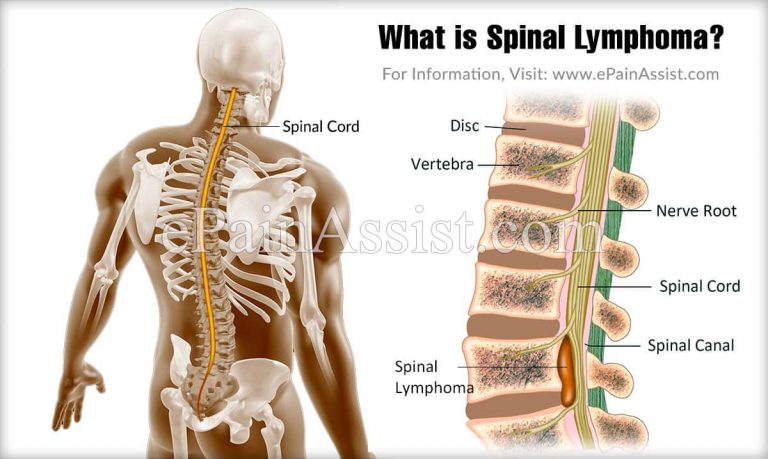 What is Spinal Lymphoma, Know its Treatment, Life Expectancy, Causes, Symptoms