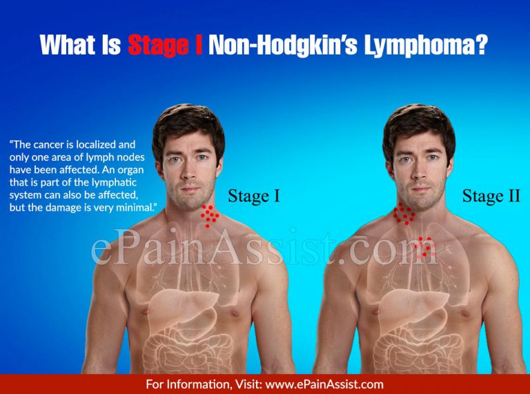 What Is Stage I Non-Hodgkin’s Lymphoma?