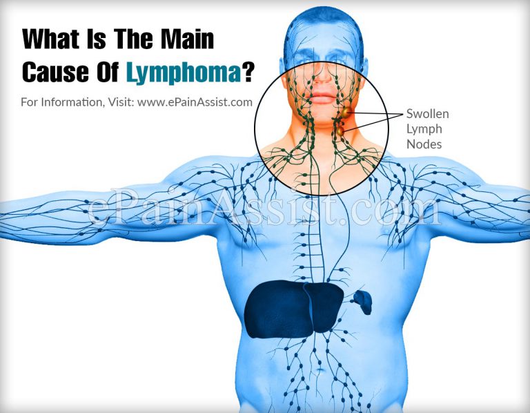 What Is The Main Cause Of Lymphoma?