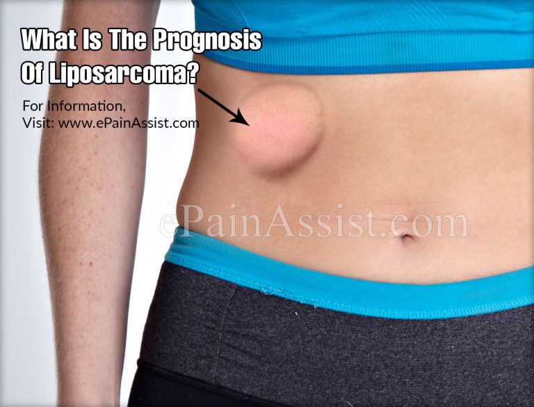 What Is The Prognosis Of Liposarcoma?