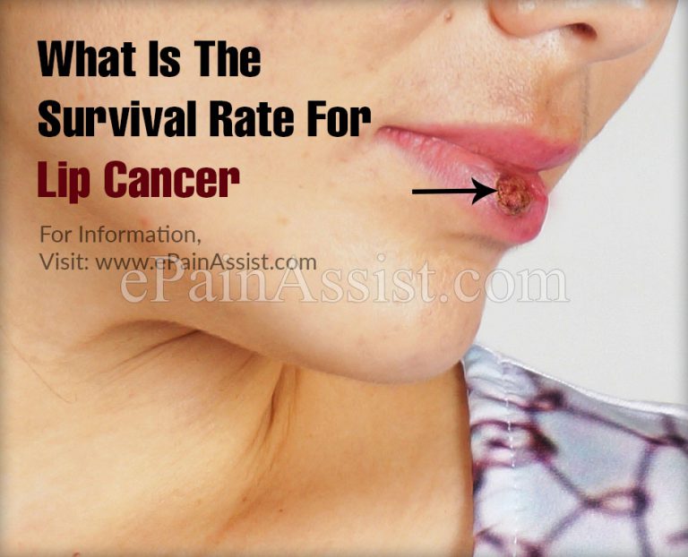 What Is The Survival Rate For Lip Cancer?