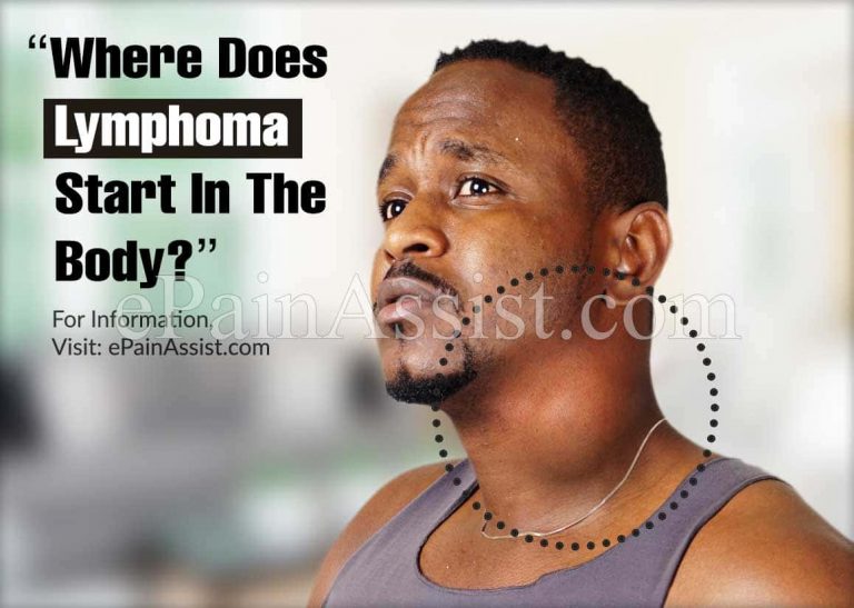 Where Does Lymphoma Start In The Body?