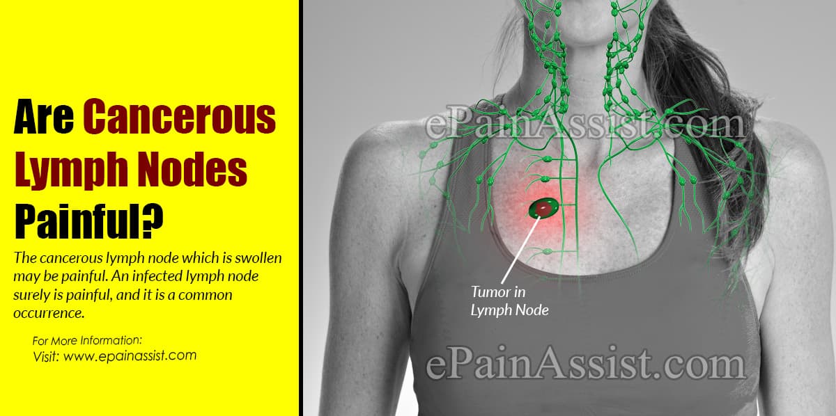 Are Cancerous Lymph Nodes Painful?