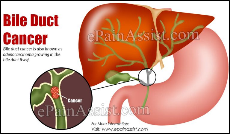 Bile Duct Cancer: Types, Causes, Symptoms, Diagnosis, Treatment, Complications