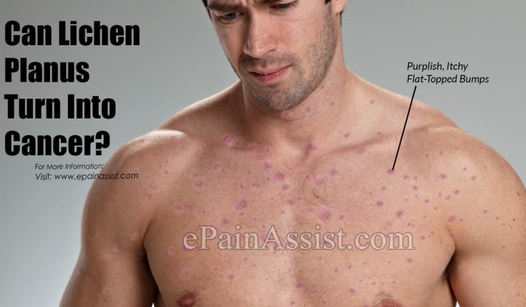 Can Lichen Planus Turn Into Cancer?