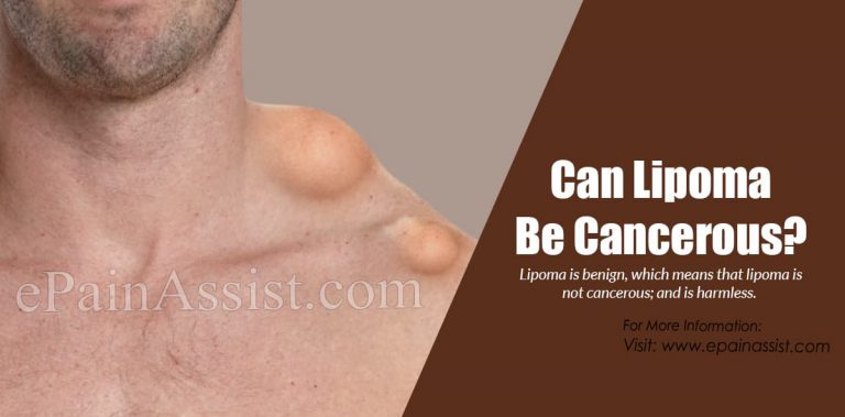 Can Lipoma Be Cancerous? Some Facts About Lipoma
