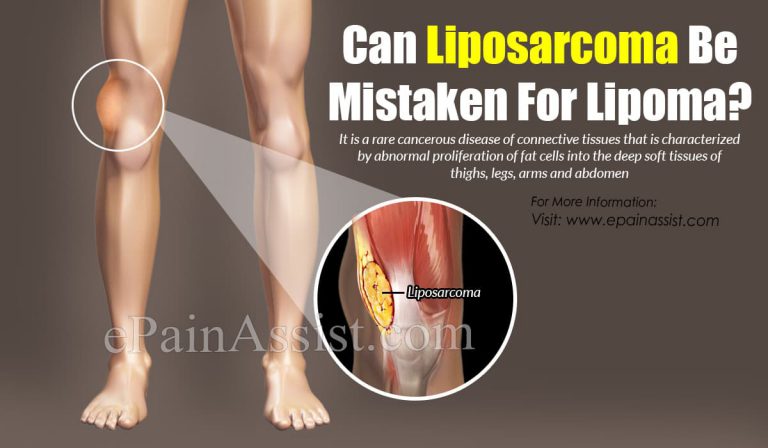 Can Liposarcoma Be Mistaken For Lipoma?