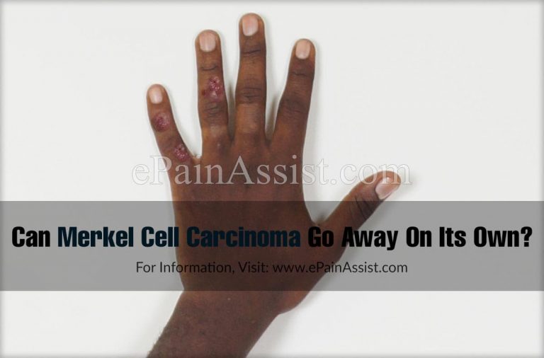 Can Merkel Cell Carcinoma Go Away On Its Own & What Are It’s Natural Remedies?
