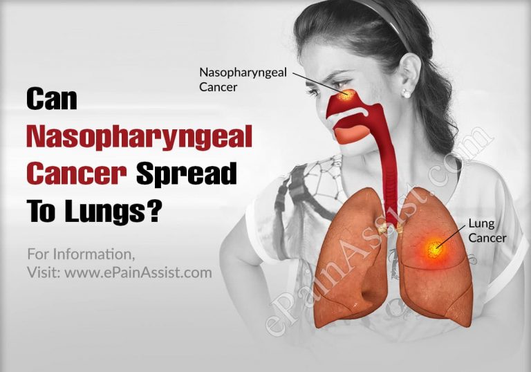 Can Nasopharyngeal Cancer Spread To Lungs?