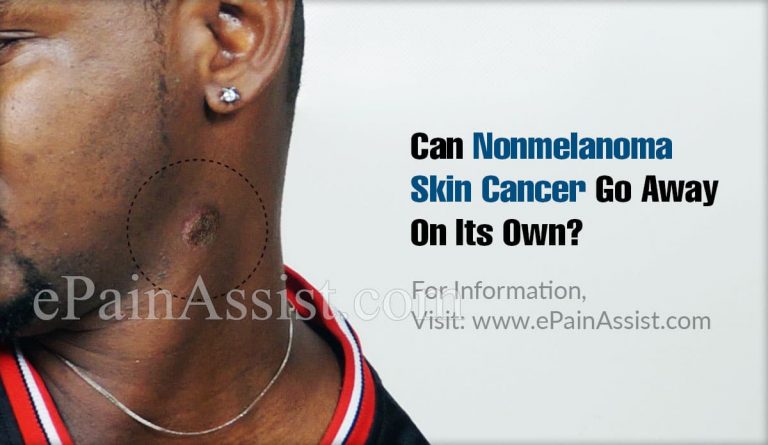 Can Nonmelanoma Skin Cancer Go Away On Its Own & What Are It’s Natural Remedies?