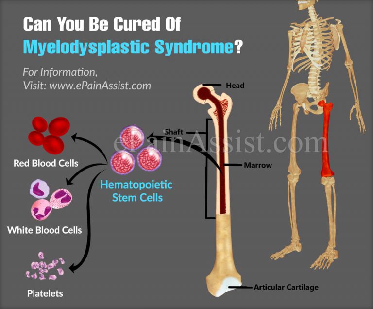 Can You Be Cured Of Myelodysplastic Syndrome?