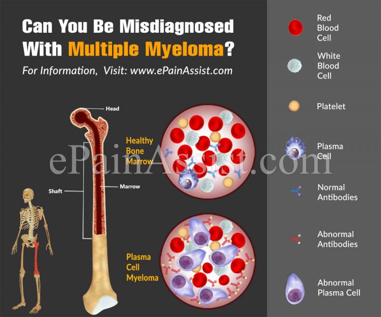 Can You Be Misdiagnosed With Multiple Myeloma?