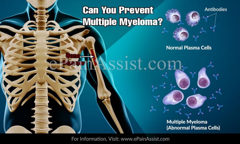 Can You Prevent Multiple Myeloma?