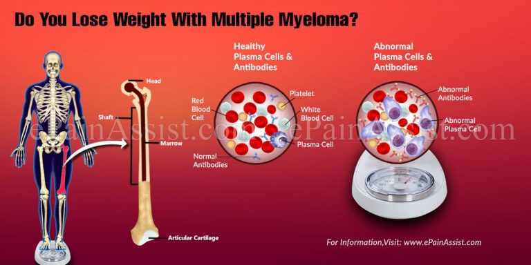 Do You Lose Weight With Multiple Myeloma?