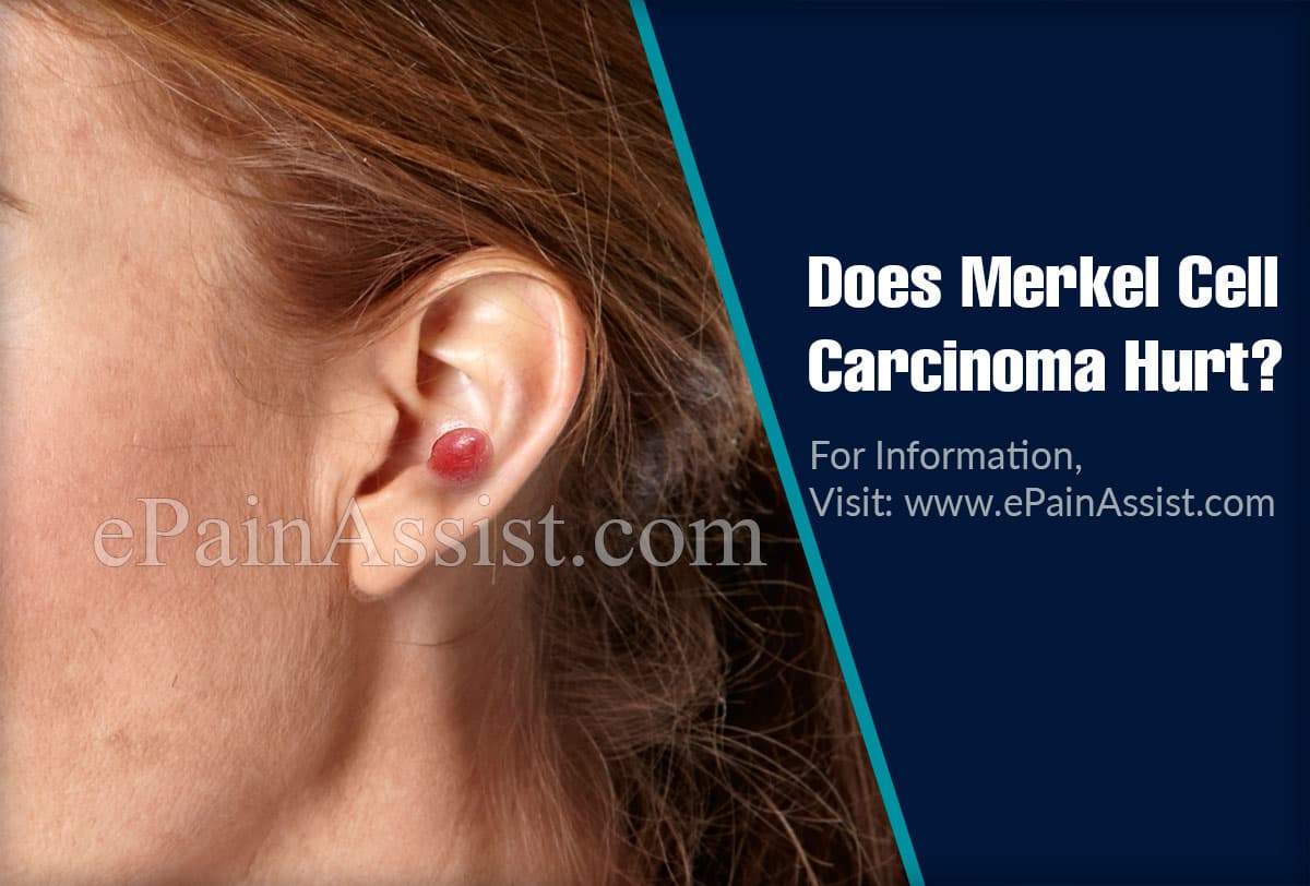 Does Merkel Cell Carcinoma Hurt?