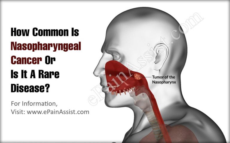How Common Is Nasopharyngeal Cancer Or Is It A Rare Disease?