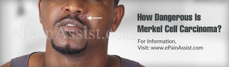 How Dangerous Is Merkel Cell Carcinoma & Is It Contagious?