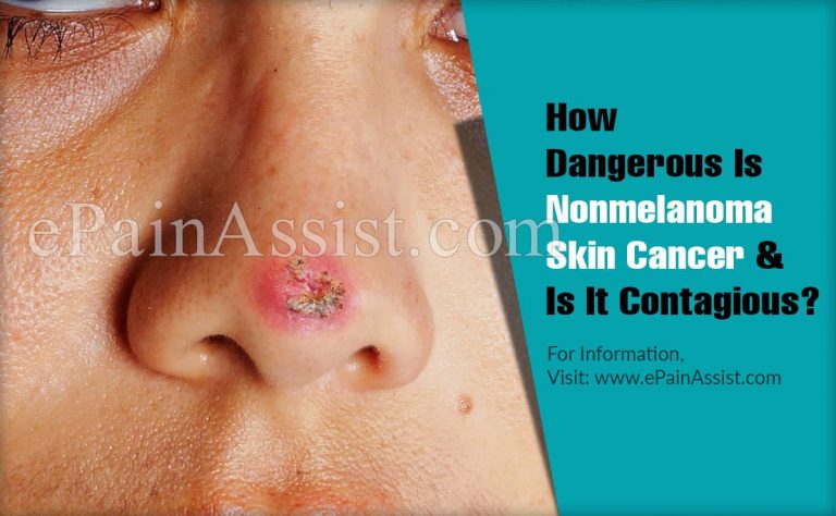 How Dangerous Is Nonmelanoma Skin Cancer & Is It Contagious?