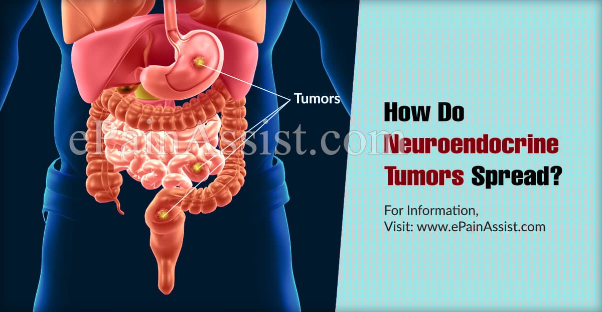 How Do Neuroendocrine Tumors Spread?