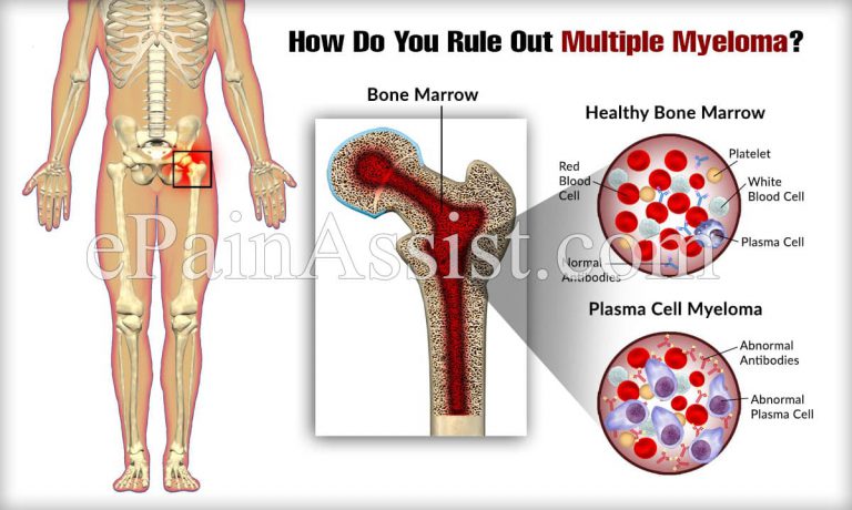 How Do You Rule Out Multiple Myeloma?