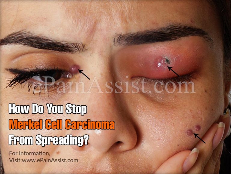 How Do You Stop Merkel Cell Carcinoma From Spreading?