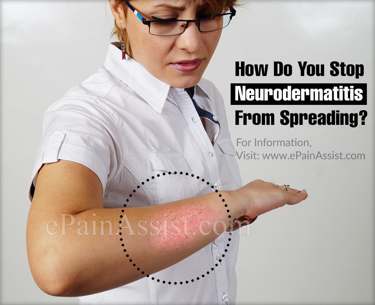 How Do You Stop Neurodermatitis From Spreading?