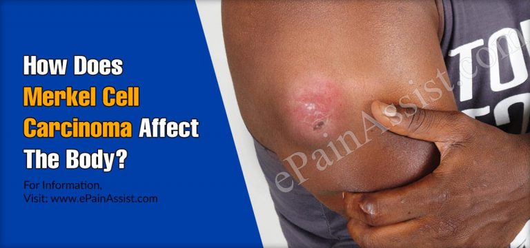 How Does Merkel Cell Carcinoma Affect The Body & What Triggers It?