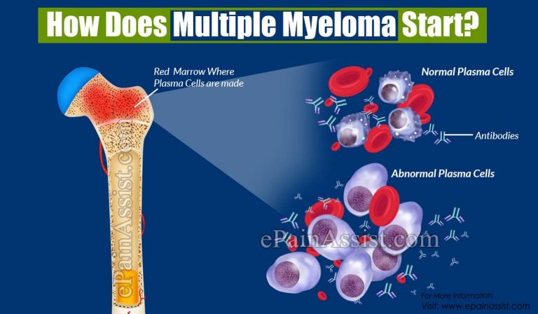 How Does Multiple Myeloma Start?