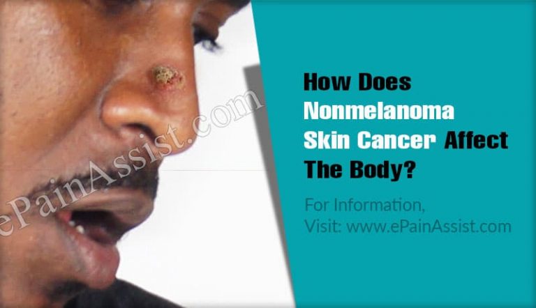 How Does Nonmelanoma Skin Cancer Affect The Body & What Triggers It?