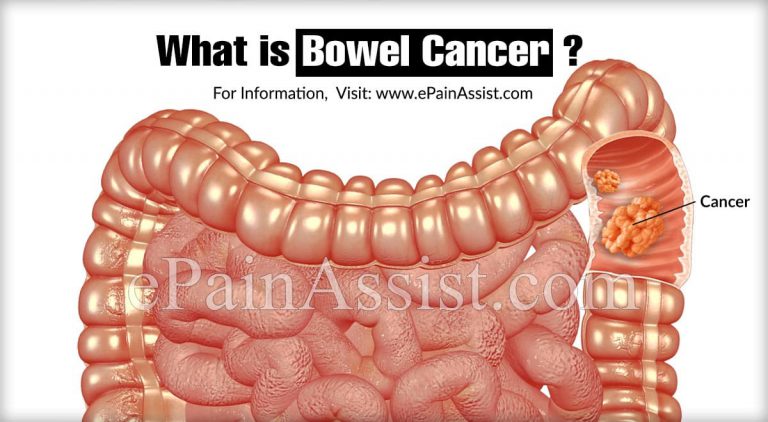 How is Bowel Cancer Diagnosed and What is its Survival Rate?