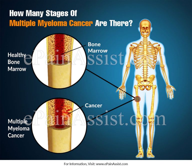 How Many Stages Of Multiple Myeloma Cancer Are There?