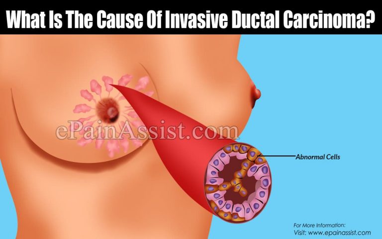Invasive Ductal Carcinoma: Causes, Symptoms, Treatment, Prognosis