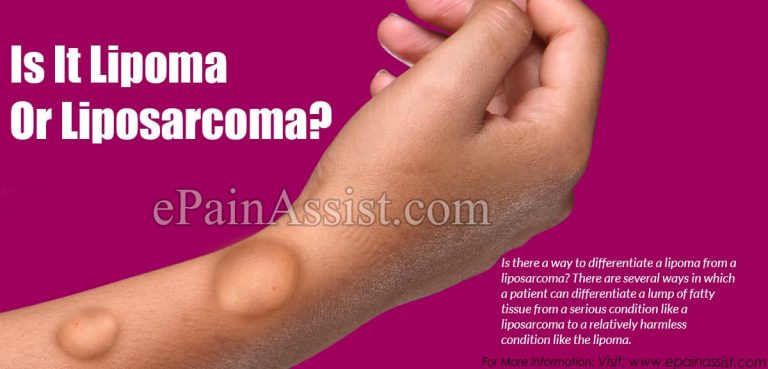 Is It Lipoma Or Liposarcoma?