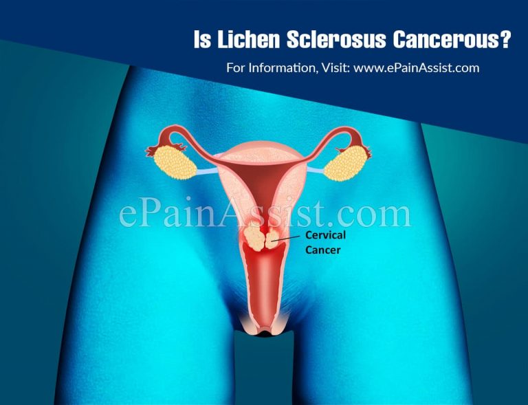 Is Lichen Sclerosus Cancerous?