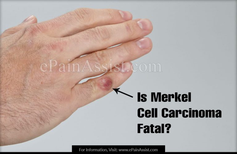 Is Merkel Cell Carcinoma Fatal & What Does Merkel Cell Cancer Look Like?