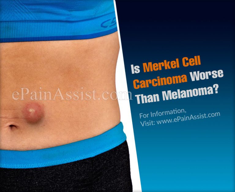 Is Merkel Cell Carcinoma Worse Than Melanoma?