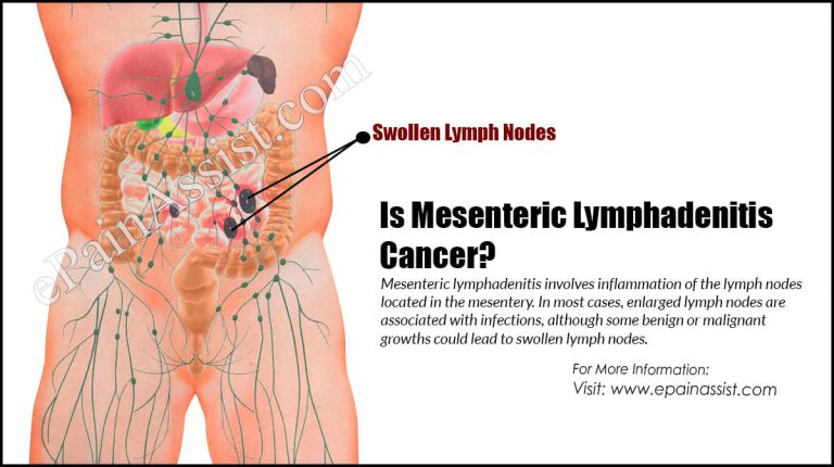 Is Mesenteric Lymphadenitis Cancer?