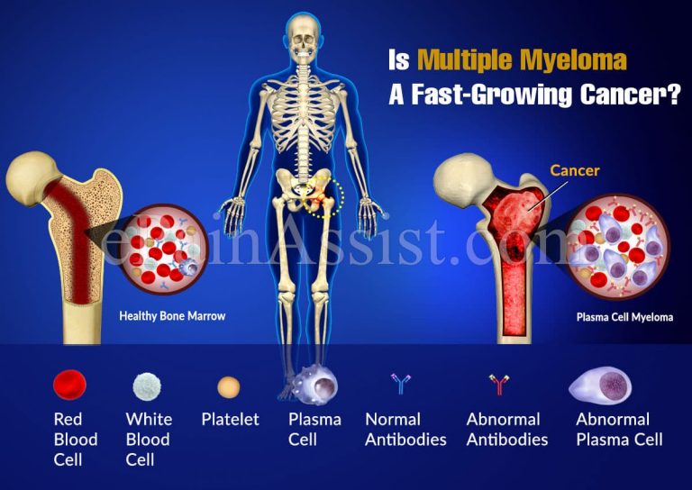 Is Multiple Myeloma A Fast-Growing Cancer?