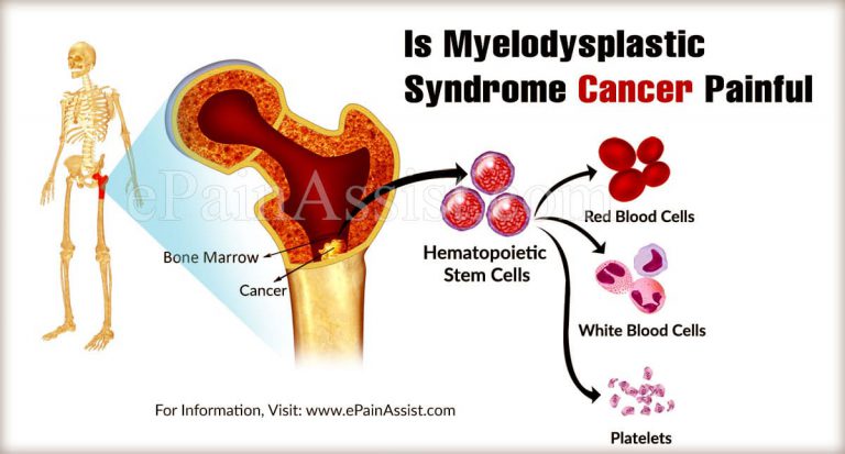 Is Myelodysplastic Syndrome Cancer Painful?