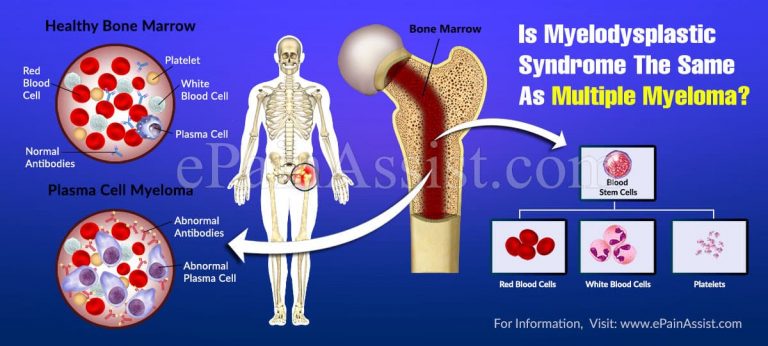Is Myelodysplastic Syndrome The Same As Multiple Myeloma?