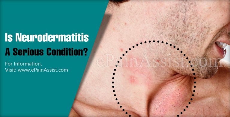 Is Neurodermatitis A Serious Condition & Can It Be Reversed?