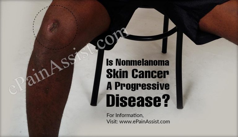 Is Nonmelanoma Skin Cancer A Progressive Disease & Alternative Treatments For It?