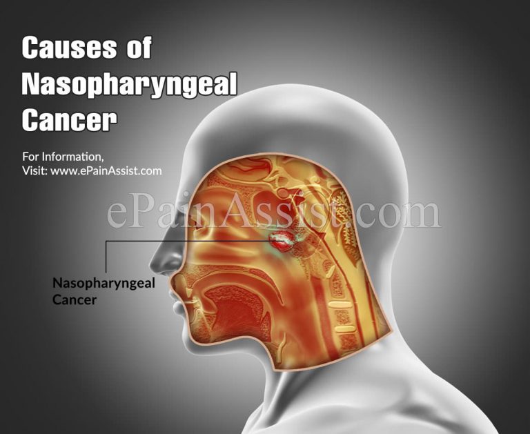 Nasopharyngeal Cancer: Stages, Causes, Symptoms, Treatment, Survival Rate