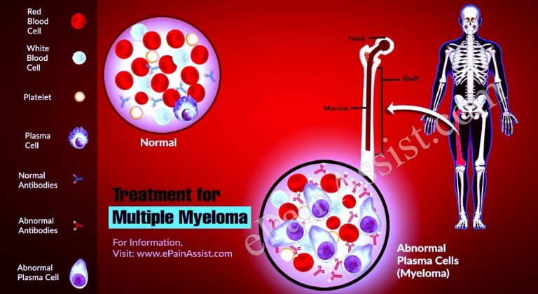 5 Risks of Stopping Multiple Myeloma Treatment
