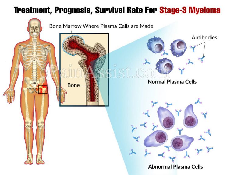 Treatment, Prognosis, Survival Rate For Stage-3 Myeloma