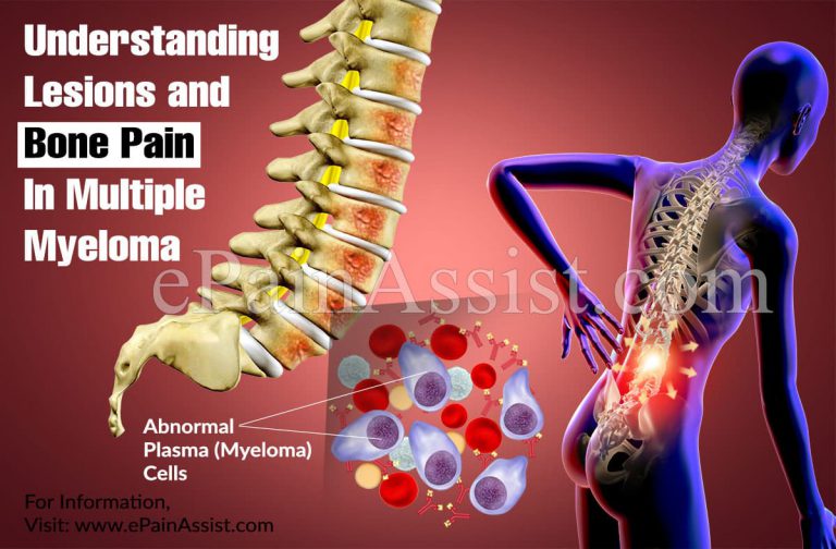 Understanding Lesions and Bone Pain In Multiple Myeloma
