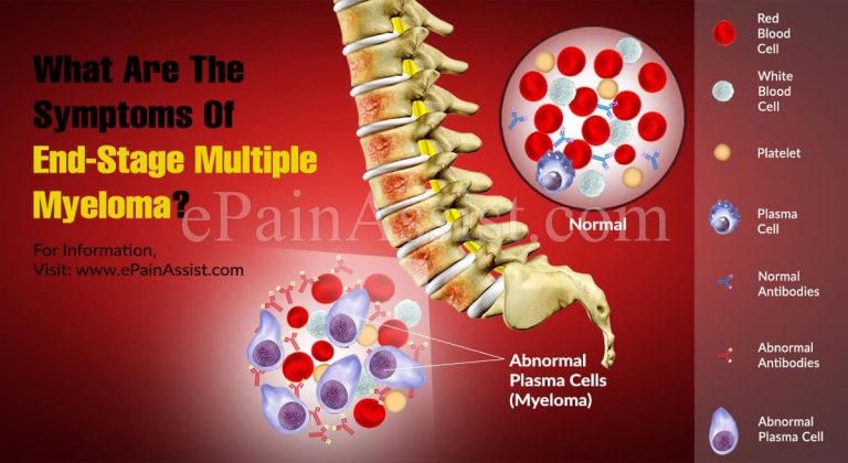 What Are The Symptoms Of End-Stage Multiple Myeloma?