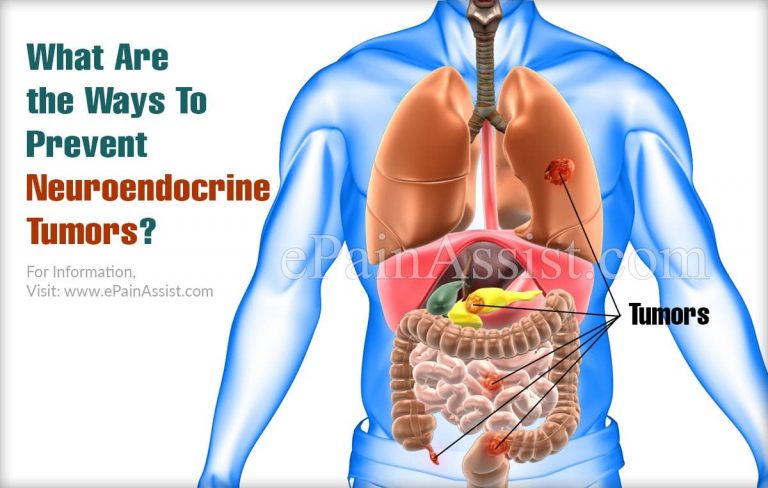 What Are the Ways To Prevent Neuroendocrine Tumors?